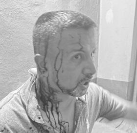 युवा संघ पर्वतमा झडप हुँदा एमाले प्रदेश सदस्य घाइते