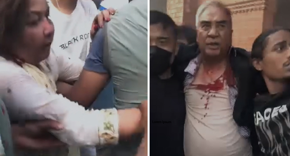 कांग्रेस सभापति देउवाको गर्धनमाथि गम्भीर चोट, टाउकोमा १२ वटा टाँका